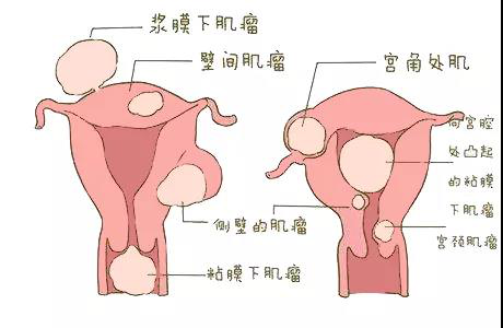 女性都害怕的子宫肌瘤，竟这么不值一提？.png